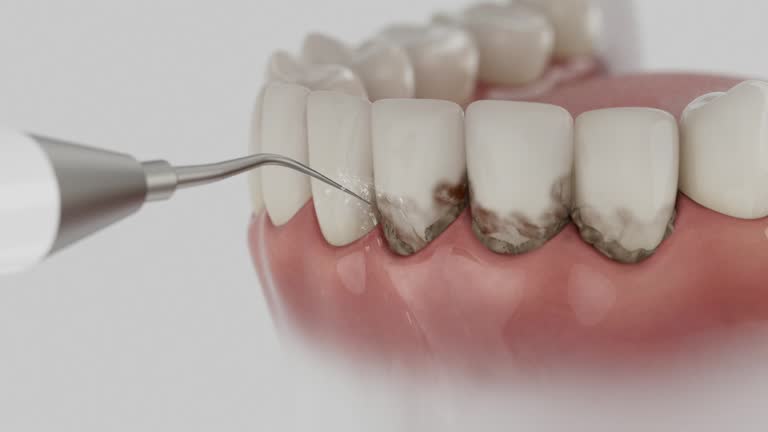Trusted Dental Veneers service in Fraser, MI - Dentist Open Now